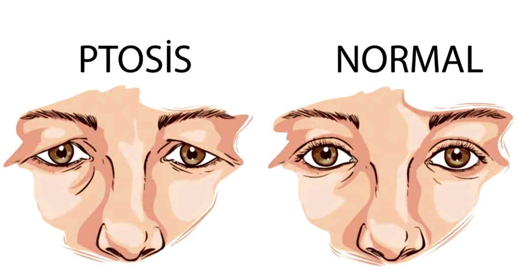 Kontakt Lensler ve Ptosis